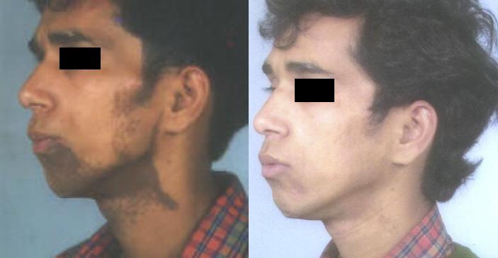 Birthmark treated by Dermabrasion-similar to Laser